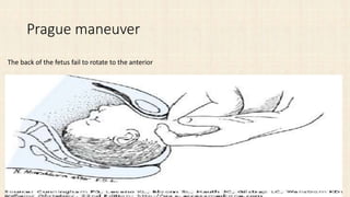Prague maneuver
The back of the fetus fail to rotate to the anterior
 