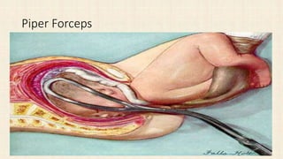 Piper Forceps
 