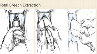 Total Breech Extraction
 