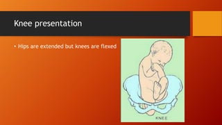 Knee presentation
• Hips are extended but knees are flexed
 