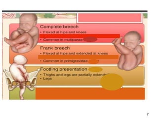 Breech presentation | PPTX