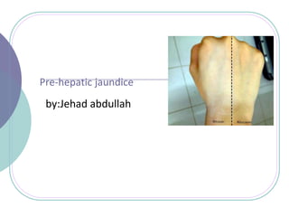 Pre-hepatic jaundice
by:Jehad abdullah
 