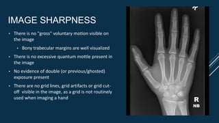 IMAGE SHARPNESS
• There is no "gross" voluntary motion visible on
the image
• Bony trabecular margins are well visualized
• There is no excessive quantum mottle present in
the image
• No evidence of double (or previous/ghosted)
exposure present
• There are no grid lines, grid artifacts or grid cut-
off visible in the image, as a grid is not routinely
used when imaging a hand R
NB
 