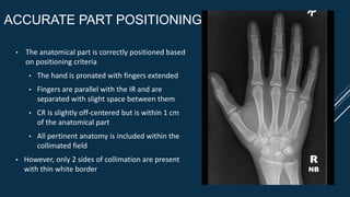 ACCURATE PART POSITIONING
• The anatomical part is correctly positioned based
on positioning criteria
• The hand is pronated with fingers extended
• Fingers are parallel with the IR and are
separated with slight space between them
• CR is slightly off-centered but is within 1 cm
of the anatomical part
• All pertinent anatomy is included within the
collimated field
• However, only 2 sides of collimation are present
with thin white border
R
NB
 