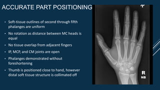 ACCURATE PART POSITIONING
• Soft-tissue outlines of second through fifth
phalanges are uniform
• No rotation as distance between MC heads is
equal
• No tissue overlap from adjacent fingers
• IP, MCP, and CM joints are open
• Phalanges demonstrated without
foreshortening
• Thumb is positioned close to hand, however
distal soft tissue structure is collimated off R
NB
 