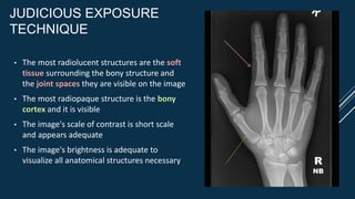JUDICIOUS EXPOSURE
TECHNIQUE
• The most radiolucent structures are the soft
tissue surrounding the bony structure and
the joint spaces they are visible on the image
• The most radiopaque structure is the bony
cortex and it is visible
• The image's scale of contrast is short scale
and appears adequate
• The image's brightness is adequate to
visualize all anatomical structures necessary R
NB
 