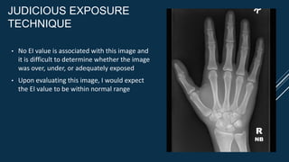 JUDICIOUS EXPOSURE
TECHNIQUE
• No EI value is associated with this image and
it is difficult to determine whether the image
was over, under, or adequately exposed
• Upon evaluating this image, I would expect
the EI value to be within normal range
R
NB
 