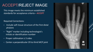 ACCEPT/REJECT IMAGE
This image meets the minimum established
standards for acceptance criteria – ACCEPT
Required Corrections:
• Include soft tissue structure of the first distal
phalanx
• "Right" marker including technologist's
initials or identification number
• Proper collimation ≥ 3 sides
• Center a perpendicular CR to third MCP joint R
NB
 