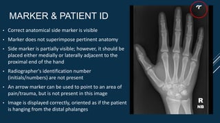 MARKER & PATIENT ID
• Correct anatomical side marker is visible
• Marker does not superimpose pertinent anatomy
• Side marker is partially visible; however, it should be
placed either medially or laterally adjacent to the
proximal end of the hand
• Radiographer's identification number
(initials/numbers) are not present
• An arrow marker can be used to point to an area of
pain/trauma, but is not present in this image
• Image is displayed correctly, oriented as if the patient
is hanging from the distal phalanges
R
NB
 