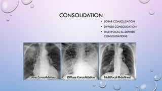 Special Considerations in Chest X-Ray Pattern Recognition for Lung ...