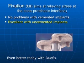 Fixation  (MB aims at relieving stress at the bone-prosthesis interface) ,[object Object],[object Object],Even better today with Duofix 