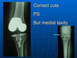 Correct cuts PS But medial laxity 