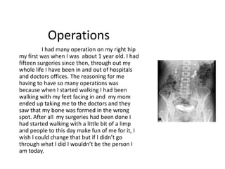 Operations
          I had many operation on my right hip
my first was when I was about 1 year old. I had
fifteen surgeries since then, through out my
whole life I have been in and out of hospitals
and doctors offices. The reasoning for me
having to have so many operations was
because when I started walking I had been
walking with my feet facing in and my mom
ended up taking me to the doctors and they
saw that my bone was formed in the wrong
spot. After all my surgeries had been done I
had started walking with a little bit of a limp
and people to this day make fun of me for it, I
wish I could change that but if I didn’t go
through what I did I wouldn’t be the person I
am today.
 