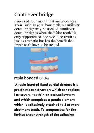 Cantilever Dental Bridge Facts
