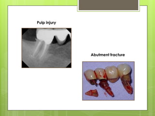 Pulp injury




              Abutment fracture
 