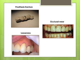 Prosthesis fracture




                      Occlusal wear




     Looseness
 
