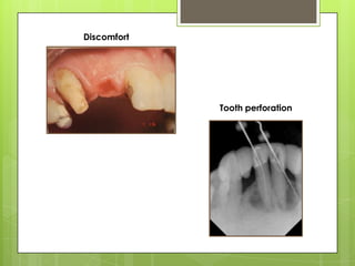 Discomfort




             Tooth perforation
 
