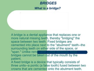 BRIDGES What is a bridge?   A bridge is a dental appliance that replaces one or more natural missing teeth, thereby &quot;bridging&quot; the space between two teeth. Fixed bridges are cemented into place next to the &quot;abutment&quot; teeth--the surrounding teeth on either side of the space, or &quot;span.&quot; Unlike removable partial dentures, fixed bridges cannot be taken out of the mouth by the patient.  A fixed bridge is a device that typically consists of three units--a pontic (a false tooth) fused between two crowns that are cemented onto the abutment teeth.  