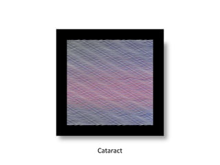 Cataract