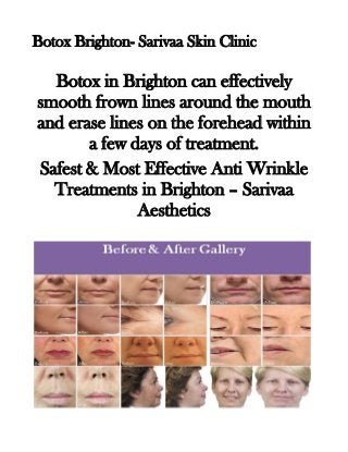 Botox Brighton- Sarivaa Skin Clinicn

Botox in Brighton can effectively
smooth frown lines around the mouth
and erase lines on the forehead within
a few days of treatment.
Safest & Most Effective Anti Wrinkle
Treatments in Brighton – Sarivaa
Aesthetics

 