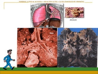 NORMAL LUNGS & ALVEOLI + HEALTHY LUNG + LUNG DAMAGED BY SMOKING 