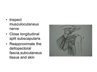 • Inspect
musculocutaneus
nerve
• Close longitudinal
split subscapularis
• Reapproximate the
deltopectoral
fascia,subcutaneus
tissue and skin
 