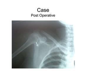 Case
Post Operative
 