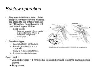Bristow operation
• The transferred short head of the
biceps & coracobrachialis muscles
are placed to the anterior glenoid
rim ( Havellius: “must be near not
over anterior glenoid rim)
– Good result :
• Coracoid process < 5 mm medial
to glenoid rim and inferior to
transverse line glenoid
• bony union
• Disadvantages:
– Internal rotation contracture
– Pathologic condition is not
corrected
– Injury to n musculocutaneus
– External rotation is limited
Good result :
• Coracoid process < 5 mm medial to glenoid rim and inferior to transverse line
glenoid
• Bony union
 