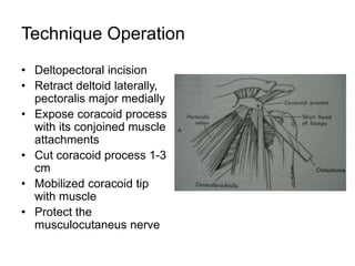 Technique Operation
• Deltopectoral incision
• Retract deltoid laterally,
pectoralis major medially
• Expose coracoid process
with its conjoined muscle
attachments
• Cut coracoid process 1-3
cm
• Mobilized coracoid tip
with muscle
• Protect the
musculocutaneus nerve
 