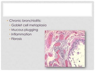 • Chronic bronchiolitis:
• Goblet cell metaplasia
• Mucous plugging
• Inflammation
• Fibrosis
 