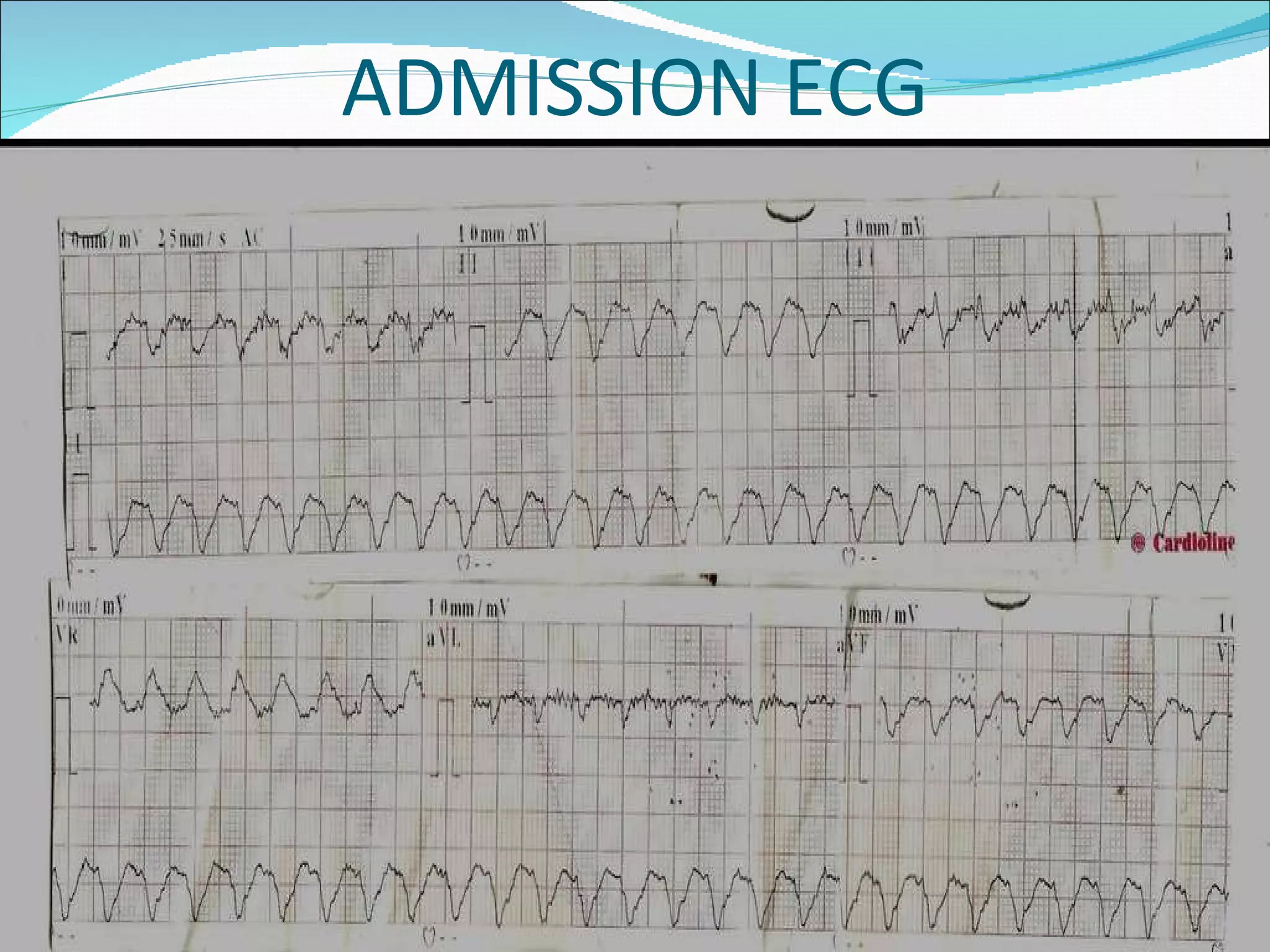 ECG: Wide Complex Tachycardia | PPT