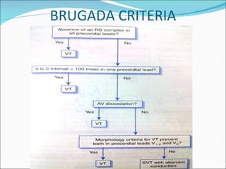 BRUGADA CRITERIA 