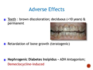 Teeth : brown discoloration; deciduous (<10 years) &
permanent
Retardation of bone growth (teratogenic)
Nephrogenic Diabetes Insipidus - ADH Antagonism;
Demeclocycline-induced
Adverse Effects
 