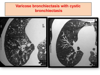 Varicose bronchiectasis with cystic
bronchiectasis
 