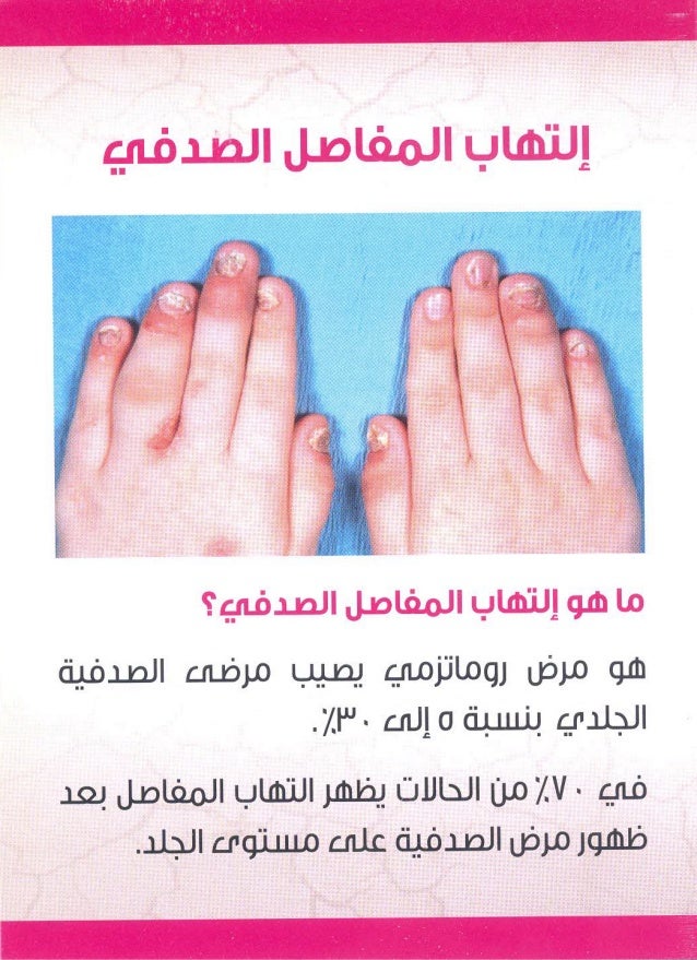 التهاب المفاصل الصدفي د زينب المصلي
