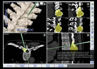In tumor surgery, critical information derived from CT and MR
images can be used simultaneously by fusing these images.
Additional visualized safety zones and intersections of tumor and
bone objects result in more precise resection of osteosarcoma and
a reduction of soft-tissue trauma.

 