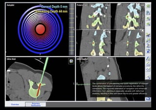 The combination of pre-planning and quick registration of adjacent
levels allows the support of complex procedures like deformity
corrections. The improved orientation of navigation and enhanced
information from planning is especially valuable with deformed
anatomy, resulting in less soft tissue trauma and greater efficiency.

 