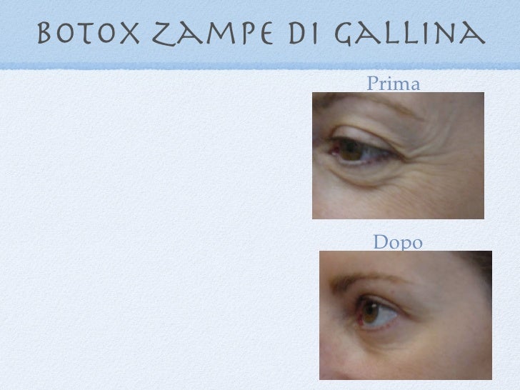 Botox Zampe Di Gallina Prima E Dopo Presentazione Oculoplastica Francesco Bernardini