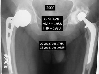 36 M AVN 
AMP – 1988 
THR – 1990 
 