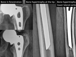 Bone in fenestration Bone hypertrophy at the tip Bone hypertrophy
lower lateral cortex
 