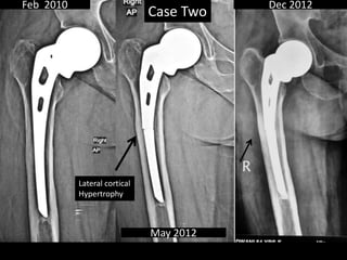 Feb 2010
May 2012
Dec 2012
Lateral cortical
Hypertrophy
Case Two
 