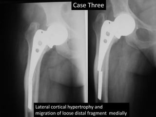 Case Three
Lateral cortical hypertrophy and
migration of loose distal fragment medially
 