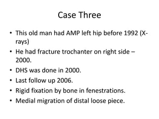Case Three
• This old man had AMP left hip before 1992 (X-
rays)
• He had fracture trochanter on right side –
2000.
• DHS was done in 2000.
• Last follow up 2006.
• Rigid fixation by bone in fenestrations.
• Medial migration of distal loose piece.
 