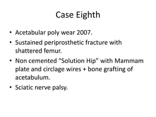 Case Eighth
• Acetabular poly wear 2007.
• Sustained periprosthetic fracture with
shattered femur.
• Non cemented “Solution Hip” with Mammam
plate and circlage wires + bone grafting of
acetabulum.
• Sciatic nerve palsy.
 