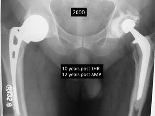 2000
10 years post THR
12 years post AMP
 