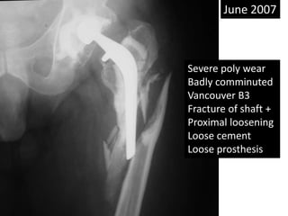 Severe poly wear
Badly comminuted
Vancouver B3
Fracture of shaft +
Proximal loosening
Loose cement
Loose prosthesis
June 2007
 