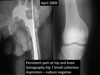 April 2009
Persistent pain at hip and knee
Sonography hip ? Small collection
Aspiration – culture negative
 
