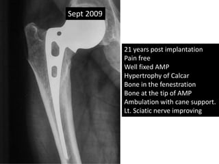 Sept 2009
21 years post implantation
Pain free
Well fixed AMP
Hypertrophy of Calcar
Bone in the fenestration
Bone at the tip of AMP
Ambulation with cane support.
Lt. Sciatic nerve improving
 