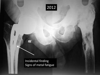 Incidental finding
Signs of metal fatigue
2012
 