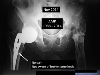 Nov 2014
No pain
Not aware of broken prosthesis
AMP
1988 - 2014
 